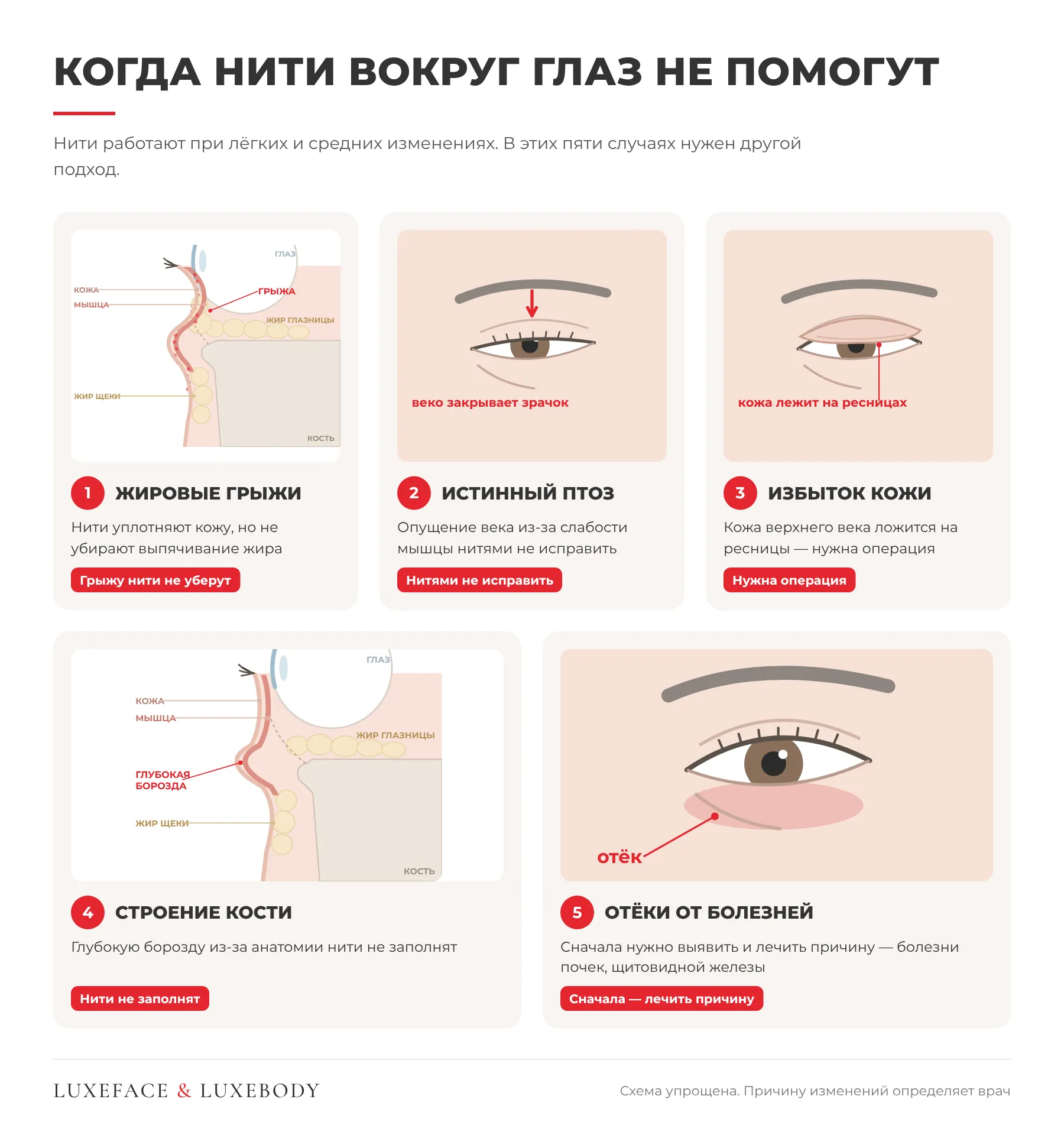 Инфографика: случаи, когда нити под глаза не помогут — грыжи, птоз, избыток кожи
