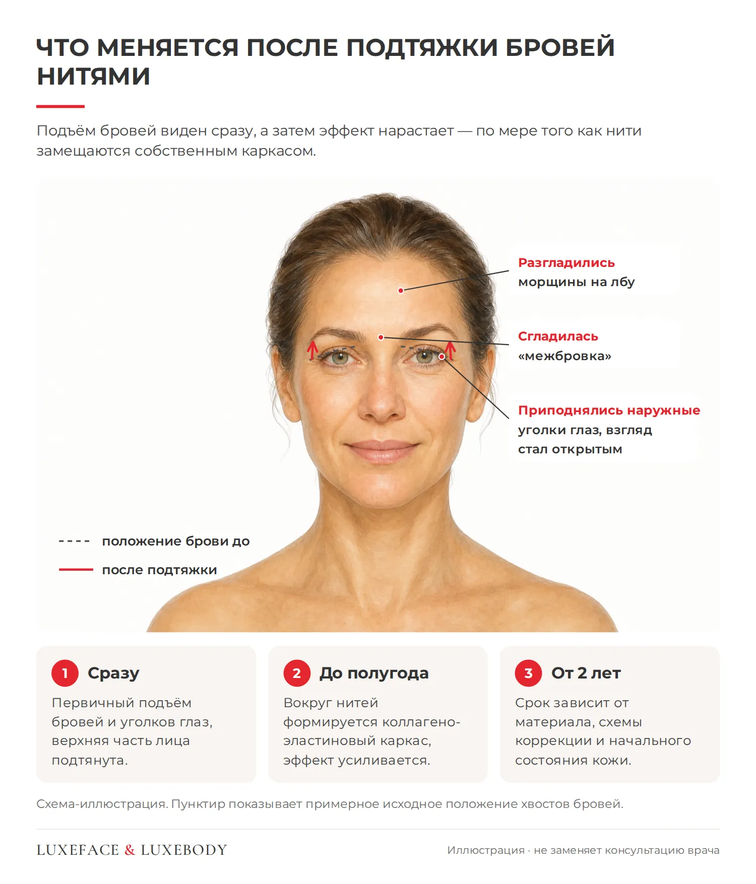 Что меняется после подтяжки бровей нитями: приподнятые хвосты бровей и открытый взгляд