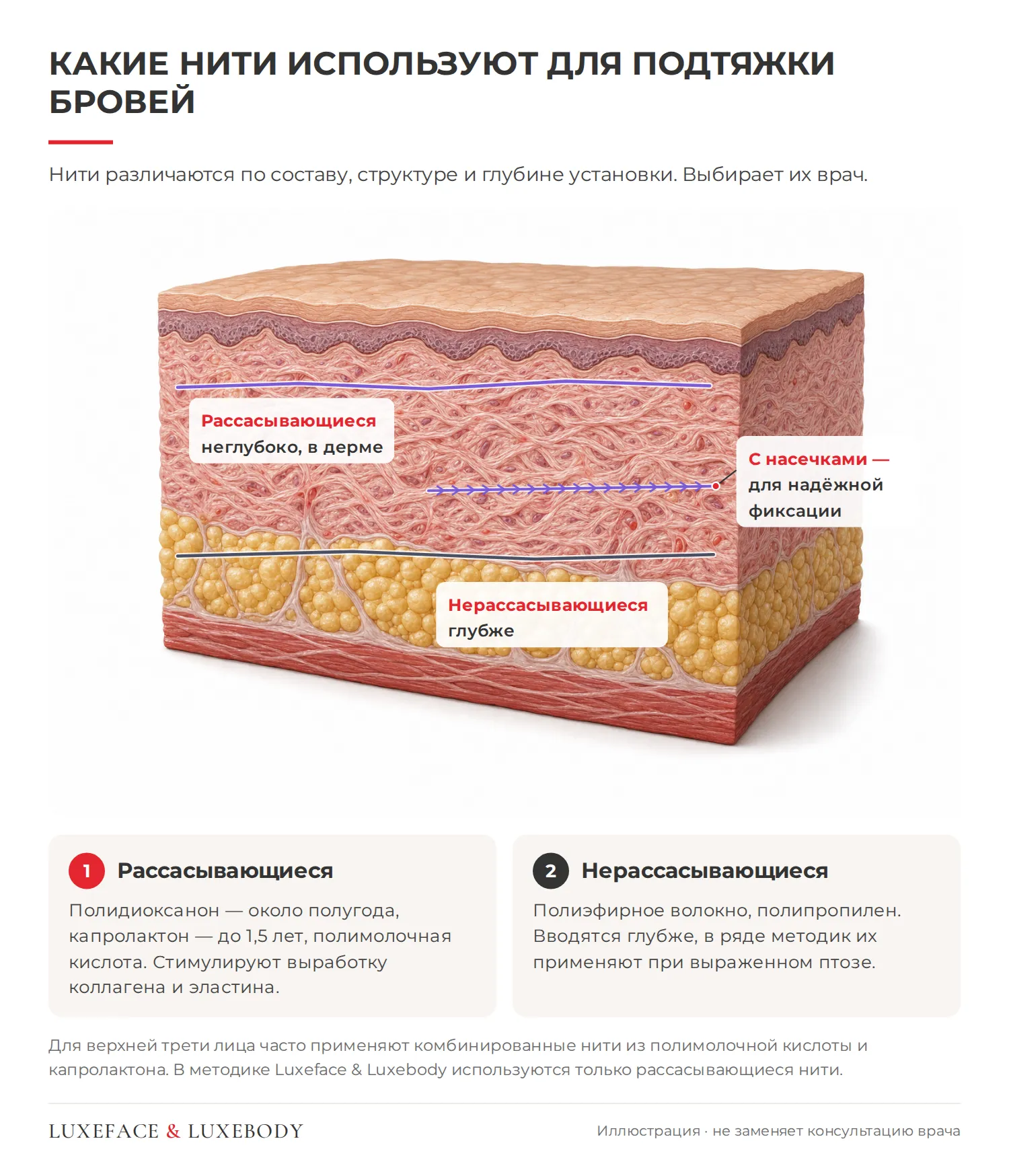 Виды нитей для подтяжки бровей в разрезе кожи: рассасывающиеся, с насечками и нерассасывающиеся
